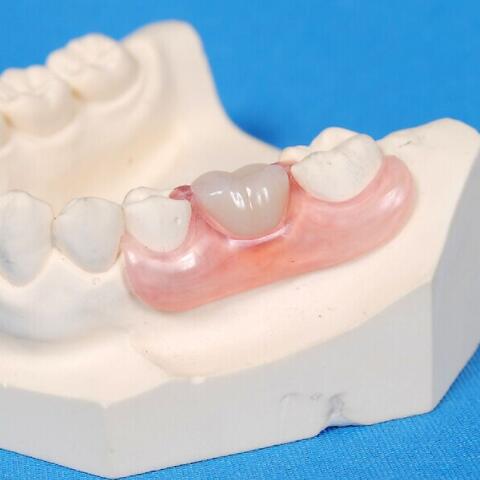 氮化硼補牙材料
